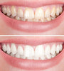 BrightSmile™ Smile Bright Instantly