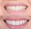 BrightSmile™ Smile Bright Instantly