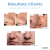 PoreEase™ Instant Clarity Treatment