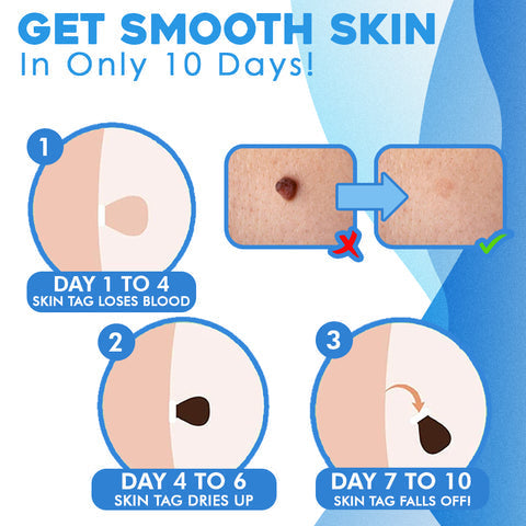 DermFree™ Pain-Free Removal