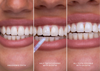 SmileShine™ Smile Bright Instantly